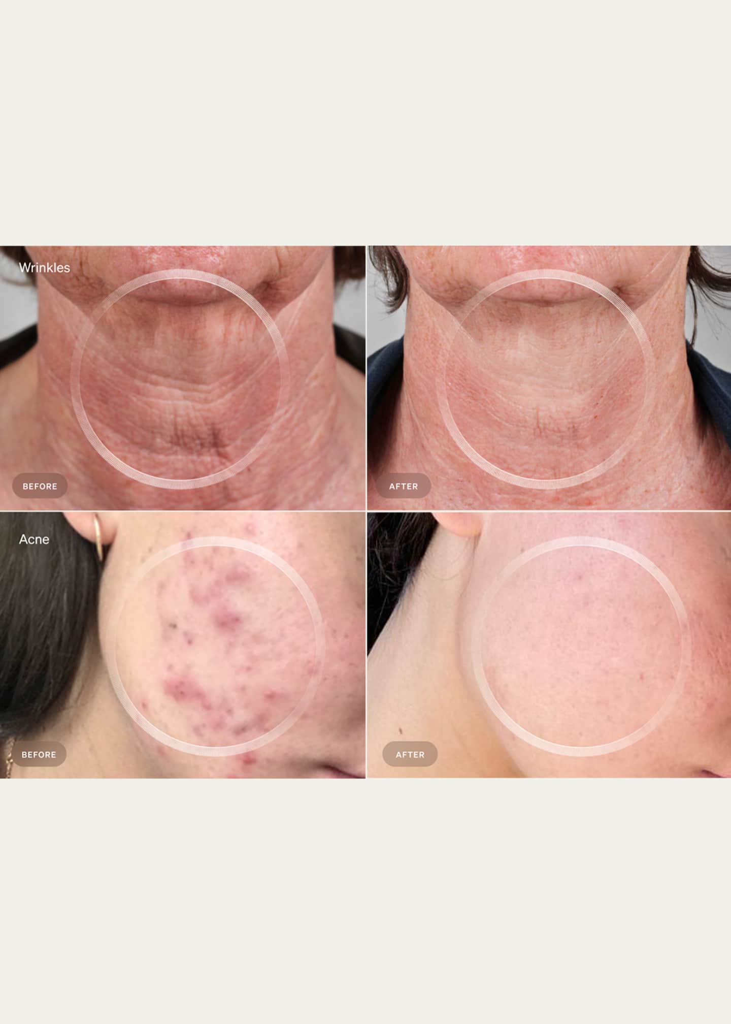 LYMA LYMA Laser Starter Kit with Exclusive Aspinal of London Pouch Image 4 of 4